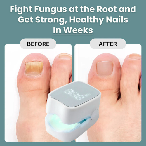 EBIN™ - Nail Fungus Laser Device