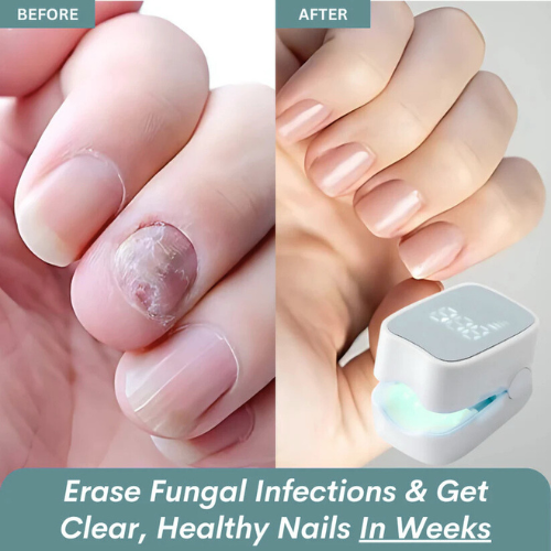 EBIN™ - Nail Fungus Laser Device