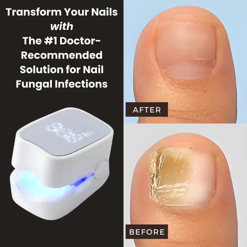 EBIN™ - Nail Fungus Laser Device